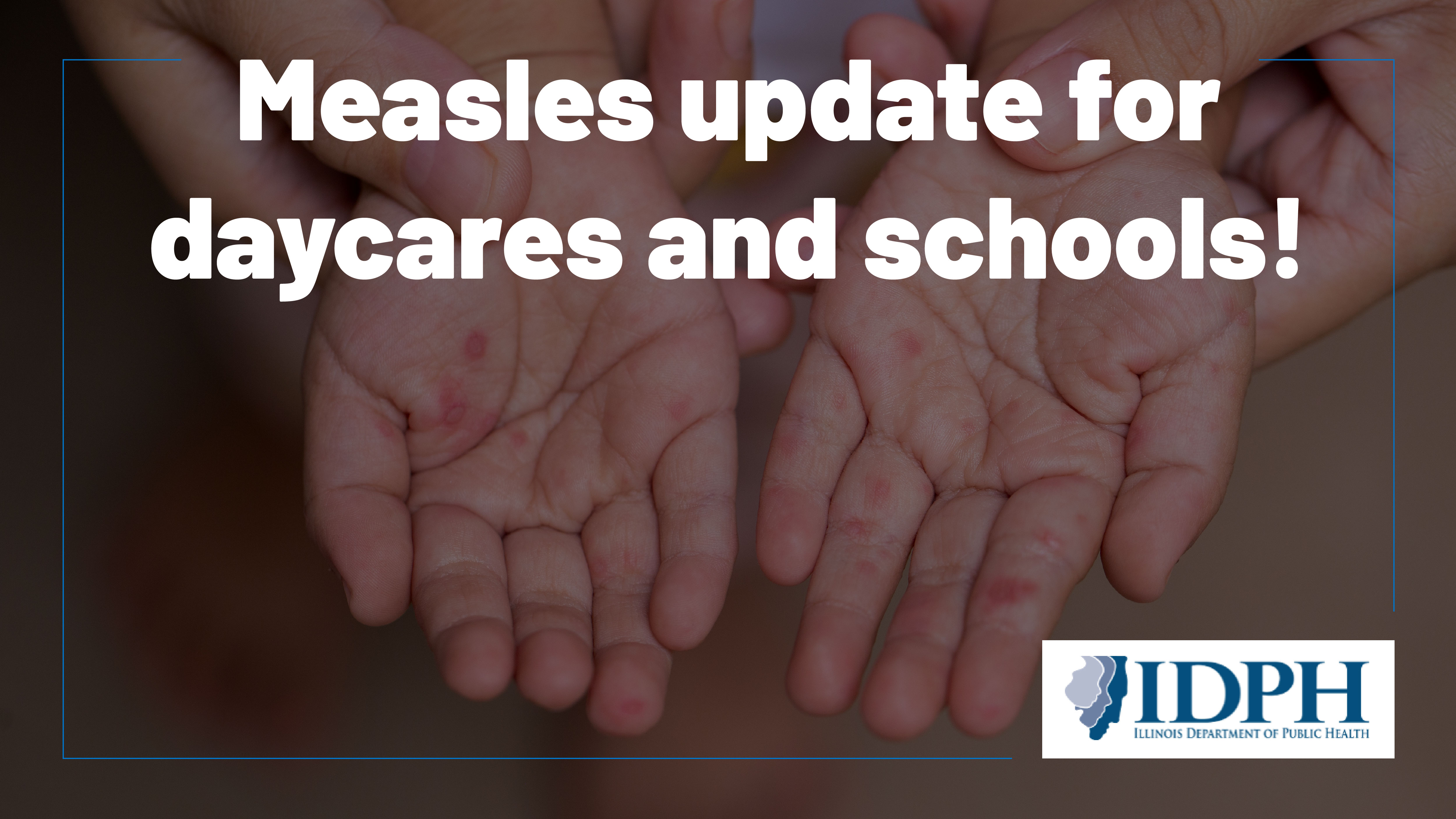 Measles update for daycares and schools! image of hands with red rash spots. Illinois Department of Public Health logo